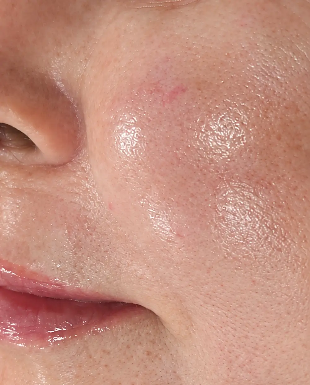 Resultado luminoso del tratamiento Baby Glow